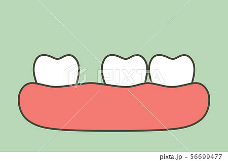 spacing teeth (diastema) spacing teeth (diastema) 56699477