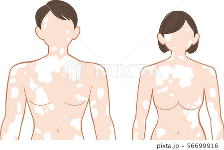 白斑　上半身　前　男女セット 56699916