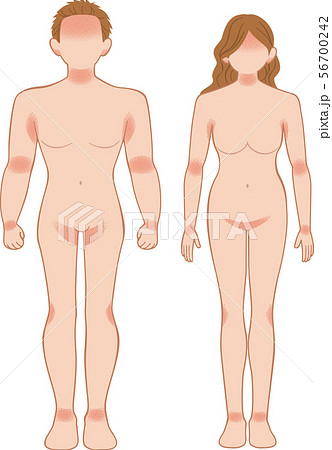 あせも・湿疹 全身 前 男女 あせも・湿疹 全身 前 男女 56700242