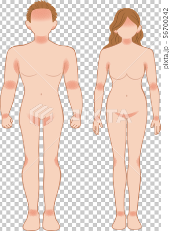 あせも・湿疹 全身 前 男女 あせも・湿疹 全身 前 男女 56700242