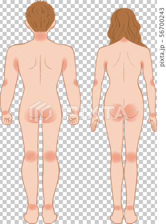 あせも・湿疹　全身　後ろ　男女 56700243