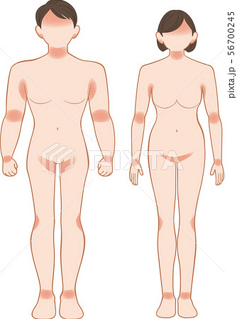 あせも・湿疹　全身　前　男女 56700245