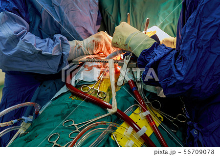 Surgery for coronary artery disease using off-pump Surgery for coronary artery disease using off-pump 56709078
