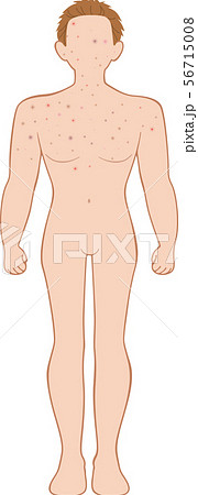 できもの 全身 前 男性 できもの 全身 前 男性 56715008