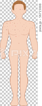 できもの 全身 前 男性 できもの 全身 前 男性 56715008