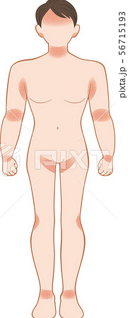 あせも・湿疹　全身　前　男性 56715193