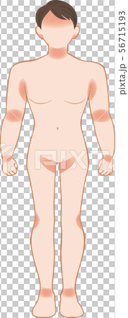 あせも・湿疹　全身　前　男性 56715193