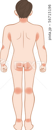 あせも・湿疹 全身 後ろ 男性 あせも・湿疹 全身 後ろ 男性 56715196