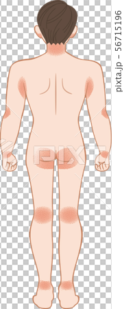 あせも・湿疹 全身 後ろ 男性 あせも・湿疹 全身 後ろ 男性 56715196