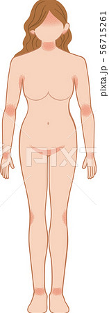あせも・湿疹　全身　前　女性 56715261
