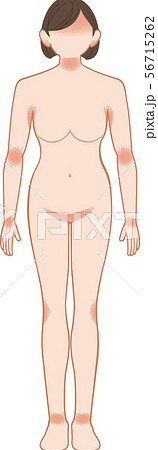あせも・湿疹　全身　前　女性 56715262