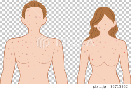 できもの　上半身　前　男女 56715562