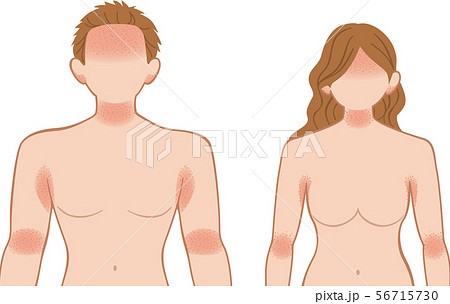 あせも・湿疹　上半身　前　男女 56715730