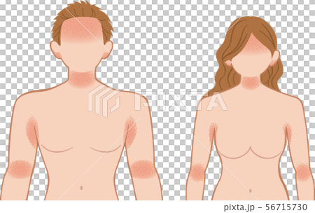 あせも・湿疹　上半身　前　男女 56715730