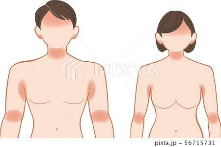 あせも・湿疹 上半身 前 男女 あせも・湿疹 上半身 前 男女 56715731