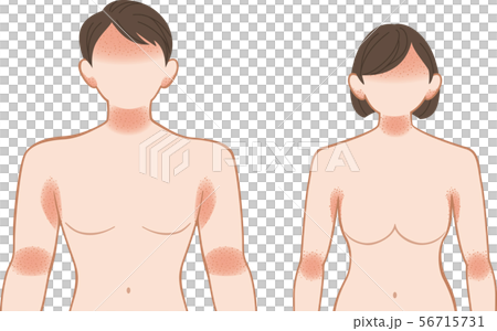 Ashemo / Eczema upper body, men and women 56715731