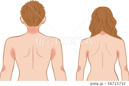あせも・湿疹　上半身　後ろ　男女 56715732