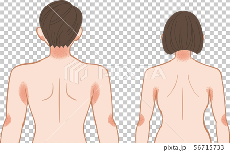 あせも 湿疹 上半身 後ろ 男女のイラスト素材