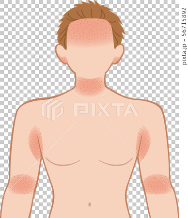 Asemo / Eczema Upper Body, Male Asemo / Eczema Upper Body, Male 56715892