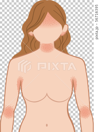 Ashemo / Eczema Upper Body Female 56716395