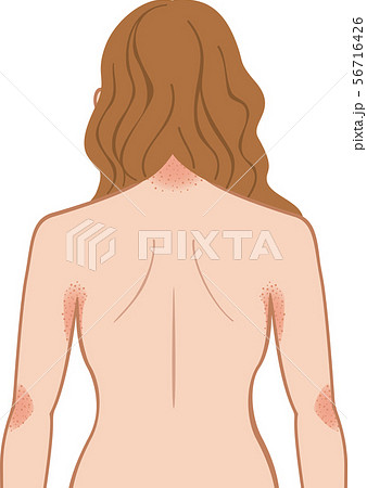 あせも・湿疹　上半身　後ろ　女性 56716426