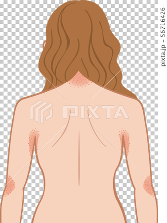 あせも・湿疹　上半身　後ろ　女性 56716426