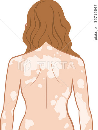 白斑 上半身 後ろ 女性 白斑 上半身 後ろ 女性 56716647