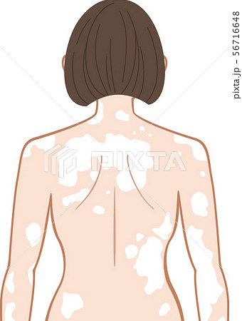 白斑 上半身 後ろ 女性のイラスト素材