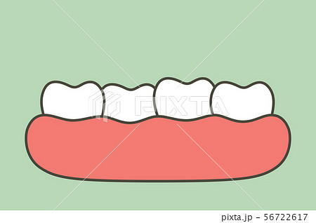crowding teeth (malocclusion) 56722617