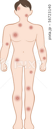 化膿　全身　前　男性 56723140