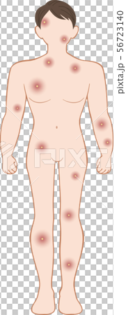 化膿　全身　前　男性 56723140