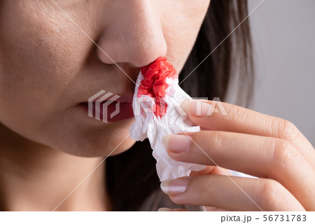 Nosebleed , a young woman suffering from nose 56731783