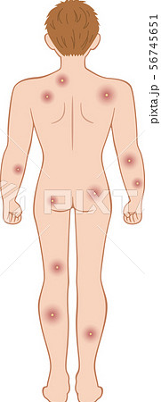 化膿　全身　後ろ　男性 56745651