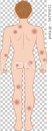 化膿　全身　後ろ　男性 56745651