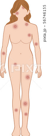 化膿　全身　前　女性 56746155