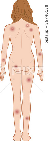 化膿　全身　後ろ　女性 56746158
