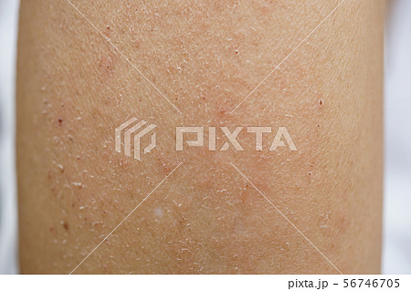 皮膚炎 乾燥性 かぶれ 湿疹 ただれ 肌荒れ かゆい かゆみ 腕 人物 あせも 汗 虫刺され 肌 皮膚炎 乾燥性 かぶれ 湿疹 ただれ 肌荒れ かゆい かゆみ 腕 人物 あせも 汗 虫刺され 肌 56746705