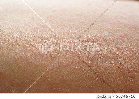 乾燥肌 皮膚炎 乾燥性 かぶれ 湿疹 肌荒れ かゆい かゆみ 腕 人物 あせも 汗 虫刺され 肌 の写真素材