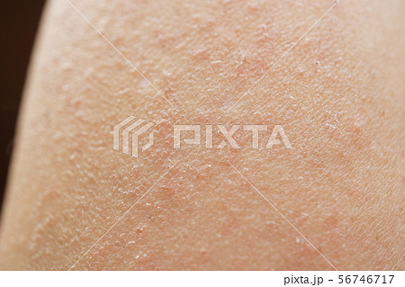 人物 皮膚 蕁麻疹 皮膚炎 肌荒れ 湿疹 乾燥性 かゆみ 腕 あせも 汗 虫刺され 肌 の写真素材