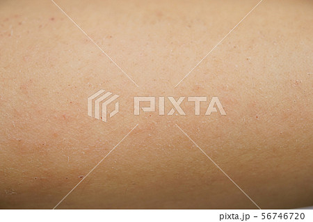 皮膚 肌荒れ 乾燥 湿疹 乾燥性 かぶれ かゆい かゆみ 腕 人物 あせも 汗 虫刺され 肌 の写真素材