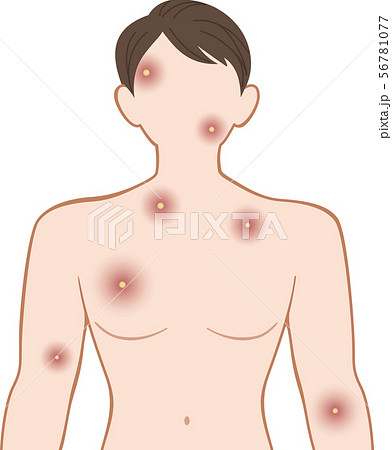 化膿　上半身　前　男性 56781077