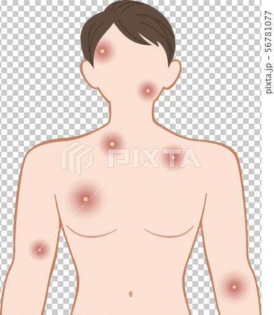 化膿　上半身　前　男性 56781077