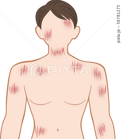 ひっかき傷 上半身 前 男性 ひっかき傷 上半身 前 男性 56781275
