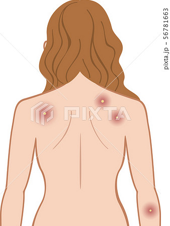 化膿　上半身　後ろ　女性 56781663
