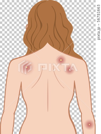 化膿　上半身　後ろ　女性 56781663