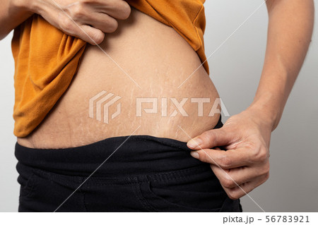Women Show off the belly after birth. Stretch Mark Women Show off the belly after birth. Stretch Mark 56783921