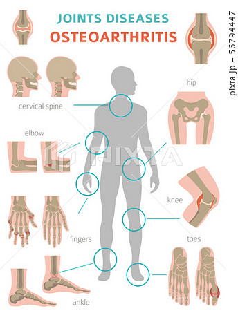 Arthritis, osteoarthritis medical infographic Arthritis, osteoarthritis medical infographic 56794447