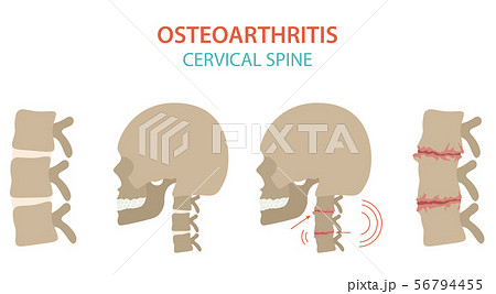 Arthritis, osteoarthritis medical infographic Arthritis, osteoarthritis medical infographic 56794455