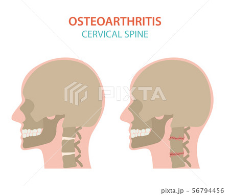 Arthritis, osteoarthritis medical infographic 56794456