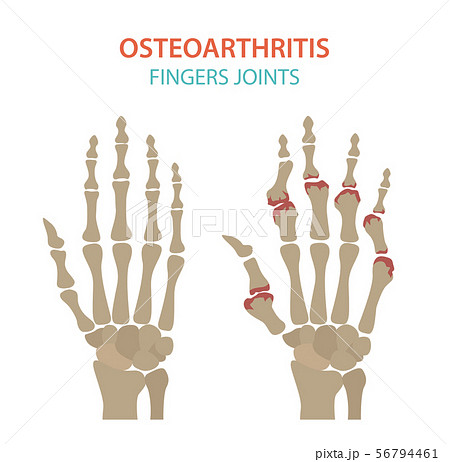 Arthritis, osteoarthritis medical infographic 56794461